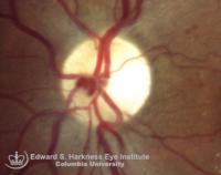 Bilateral prepapillary vascular loops.